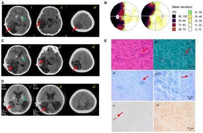 Identification of a Novel Variant in MT-CO3 Causing MELAS